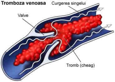 Tratamentul trombozei